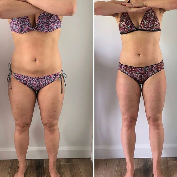 Avant et après le traitement slimwave d'une femme ronde. La photo d'après révèle une perte de poids réussie, d'une quinzaine de kilos.