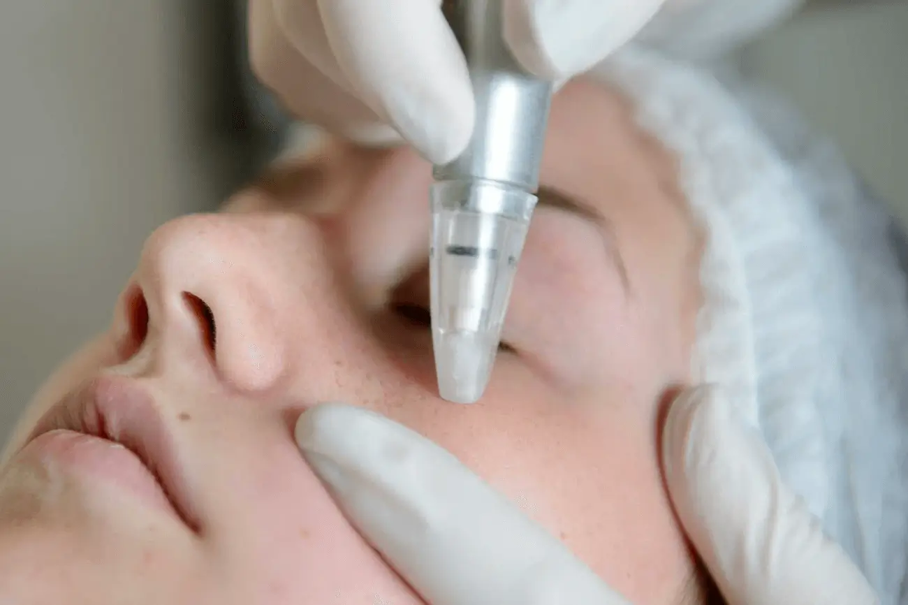 Microdermabrasion chemical peel which is right for me
